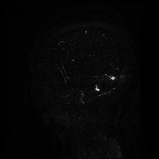 Normal noncontrast MR venography (Radiopaedia 87578-103957 A 145).jpg
