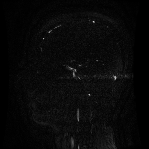 Normal noncontrast MR venography (Radiopaedia 87578-103957 A 68).jpg