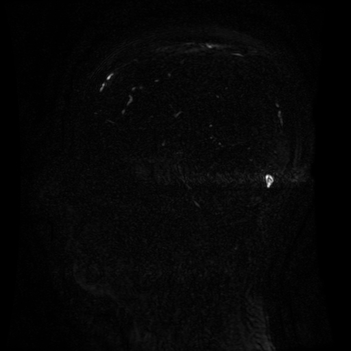 Normal noncontrast MR venography (Radiopaedia 87578-103957 A 78).jpg