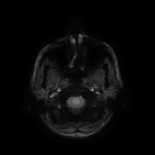 Normal noncontrast MR venography (Radiopaedia 87578-103957 Axial SWI 72).jpg