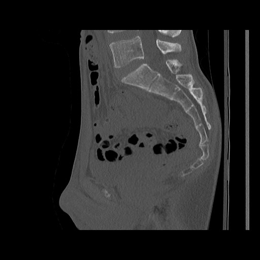 Normal pelvis (Radiopaedia 51473-57238 Sagittal bone window 76).jpg