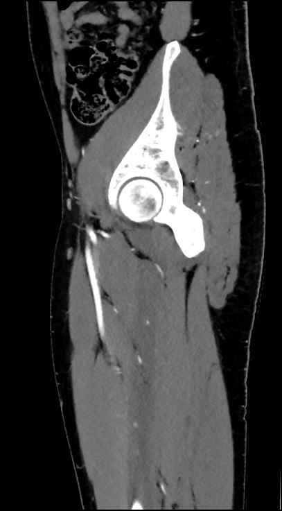 Normal pelvis CT angiogram (Radiopaedia 84966-100481 C 30).jpg