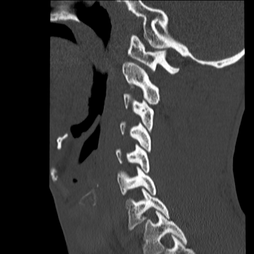 File:Normal trauma cervical spine (Radiopaedia 41017-43760 Sagittal bone window 13).png