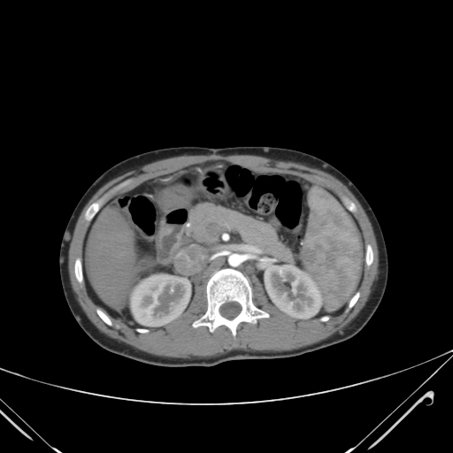 File:Nutmeg liver- Budd-Chiari syndrome (Radiopaedia 46234-50635 A 30).png
