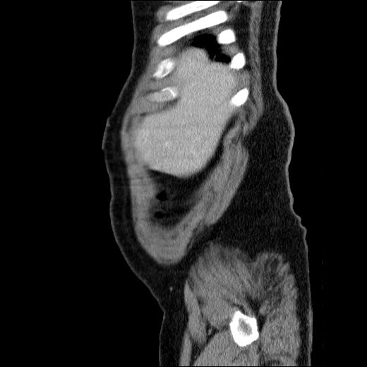 Obstructing ureteric calculus (Radiopaedia 49281-54373 C 79).jpg