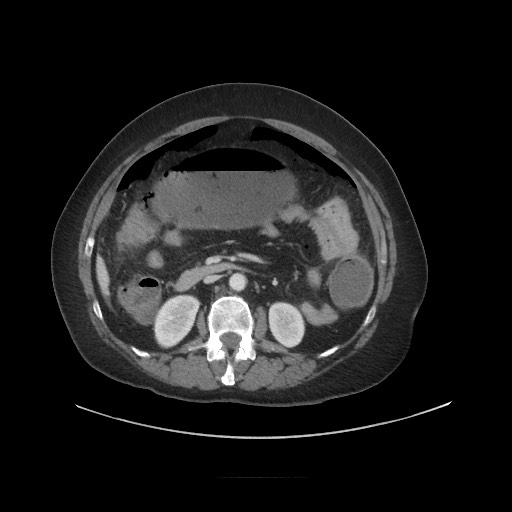 Obstructive distal colonic adenocarcinoma causing cecal perforation (Radiopaedia 86830-102989 A 91).jpg