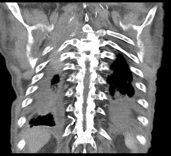 File:Obstructive superior vena cava tumor thrombus (Radiopaedia 28046-28306 B 43).jpg