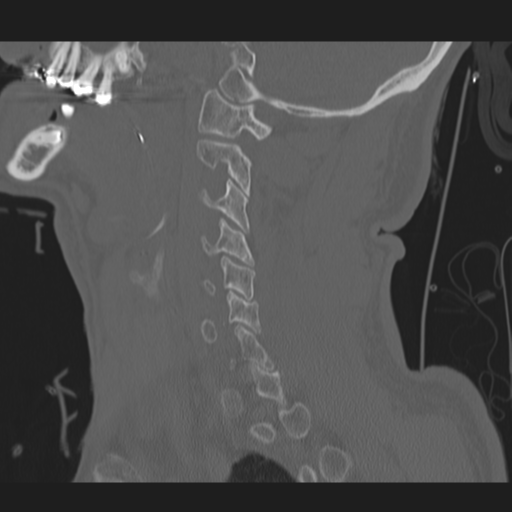 File:Occipital condyle fracture (Radiopaedia 33467-34517 Sagittal bone window 22).png