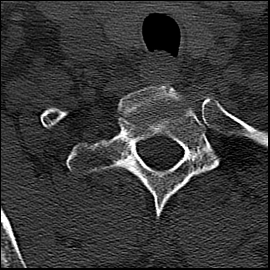 Occipital condyle fracture (type 1) (Radiopaedia 87670-104084 Axial bone window 83).jpg
