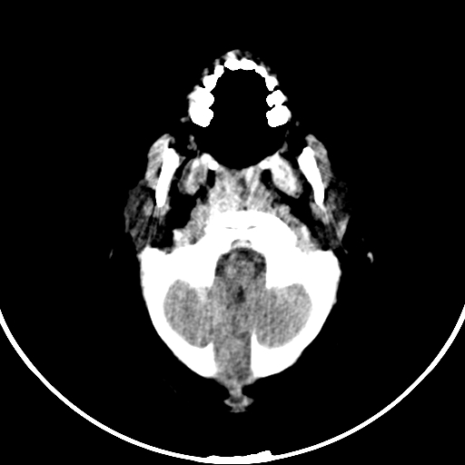 Occipital encephalocele (Radiopaedia 87339-103636 Axial non-contrast 17).jpg