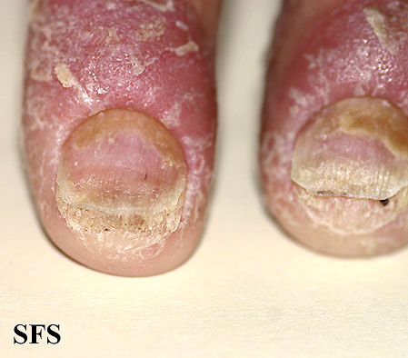 File:Psoriasis (Dermatology Atlas 39).jpg