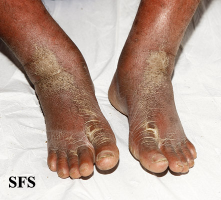 File:Psoriasis (Dermatology Atlas 71).jpg