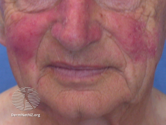 Rosacea (DermNet NZ acne-red-face-3603).jpg