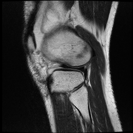 File:ACL acute full thickness tear - deep lateral femoral sulcus sign (Radiopaedia 38594-40740 Sagittal T2 18).jpg