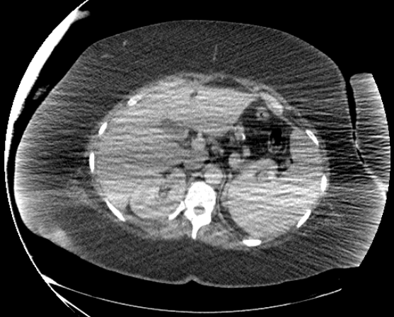 File:Abdominal abscess - pre and post percutaneous drainage (Radiopaedia 60209-67816 Axial 79).png