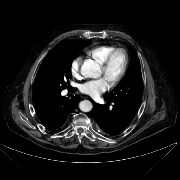 Abdominal aortic aneurysm (Radiopaedia 25855-26001 Axial C+ arterial phase 1).jpg