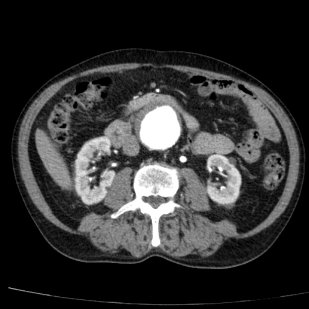 Abdominal aortic aneurysm (Radiopaedia 29248-29660 Axial C+ arterial phase 41).jpg