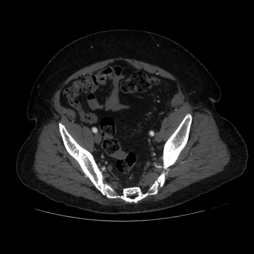File:Abdominal aortic aneurysm (Radiopaedia 57318-64259 Axial C+ arterial phase 62).jpg