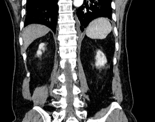 Abdominal aortic aneurysm (Radiopaedia 67117-76452 Coronal C+ arterial phase 84).jpg