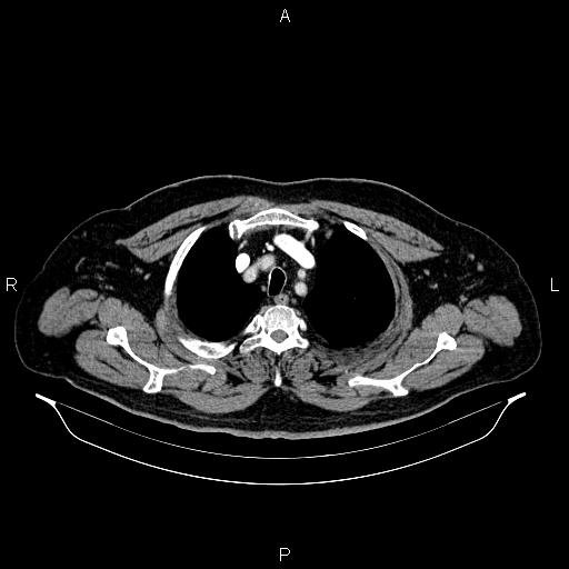 Abdominal aortic aneurysm (Radiopaedia 83094-97462 Axial renal cortical phase 14).jpg