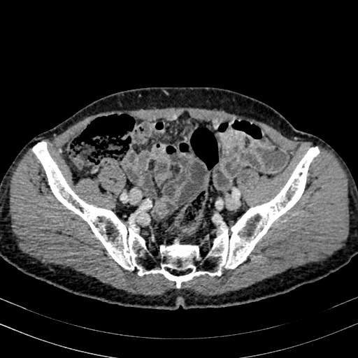 Abdominal aortic aneurysm (Radiopaedia 83581-98689 Axial C+ portal venous phase 89).jpg