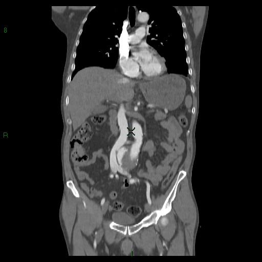 File:Abdominal aortic aneurysm rupture with aortocaval fistula (Radiopaedia 14897-14841 Coronal C+ arterial phase 24).jpg
