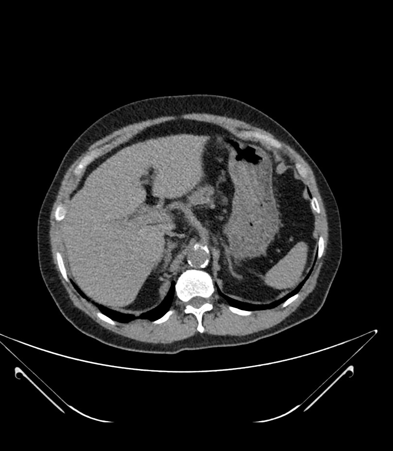 Abdominal aortic aneurysm with thrombus fissuration (Radiopaedia 46218-50618 Axial non-contrast 12).jpg