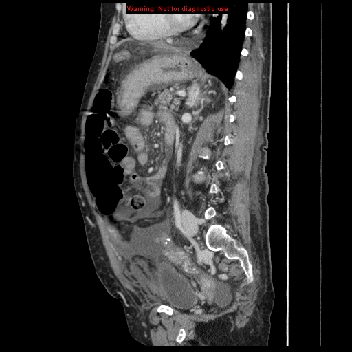 Abdominal wall hematoma (Radiopaedia 9427-10112 Sagittal C+ portal venous phase 42).jpg