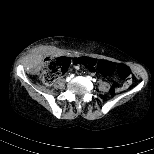 Abdominal wall hematoma with active bleeding (Radiopaedia 83915-99117 Axial renal cortical phase 82).jpg
