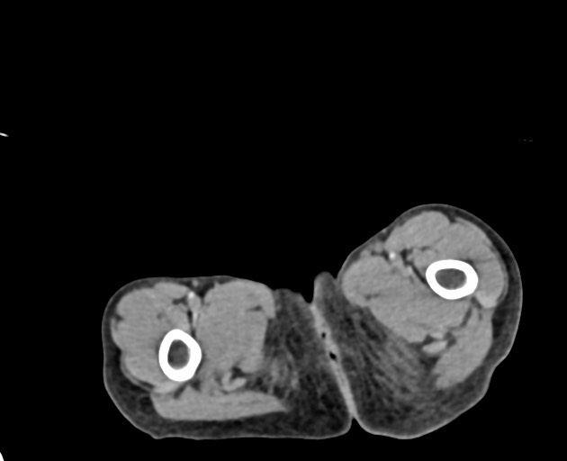 Abdominopelvic rhabdomyosarcoma (Radiopaedia 78356-90984 Axial C+ portal venous phase 168).jpg