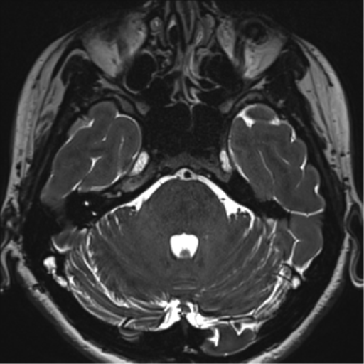 Abducens nerve palsy (Radiopaedia 51069-56648 Axial T2 fat sat 32).png