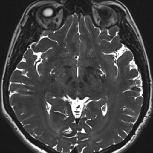 Abducens nerve palsy (Radiopaedia 51069-56648 Axial T2 fat sat 83).png