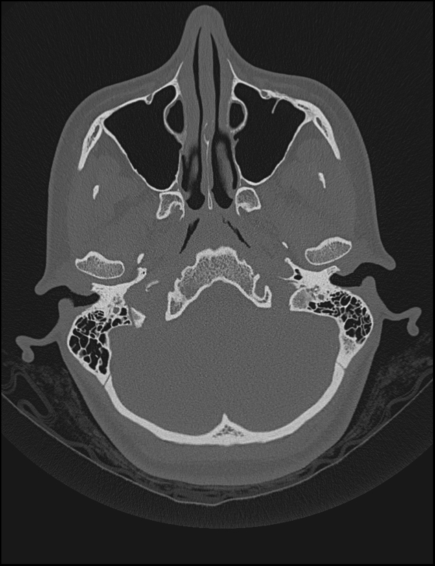 Aberrant right internal carotid artery (Radiopaedia 65191-74198 Axial non-contrast 26).jpg