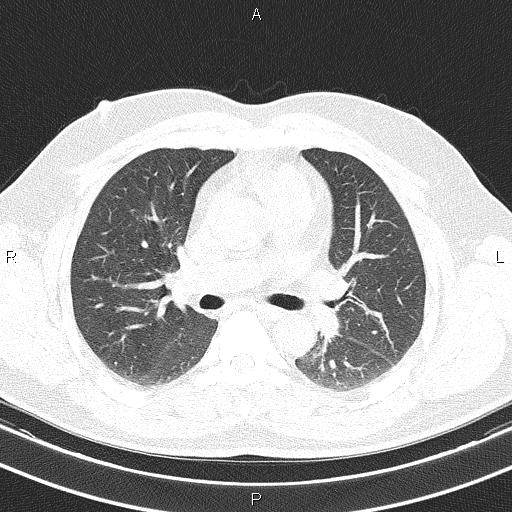 File:Aberrant right subclavian artery (Radiopaedia 87093-103354 Axial lung window 49).jpg
