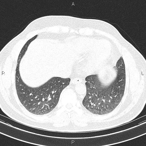 Aberrant right subclavian artery (Radiopaedia 87093-103354 Axial lung window 84).jpg