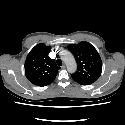 Accessory left horizontal fissure with lingular pneumonia (Radiopaedia 53763-59843 Axial C+ CTPA 27).jpg