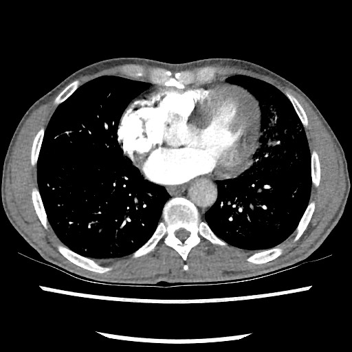 Accessory left horizontal fissure with lingular pneumonia (Radiopaedia 53763-59843 Axial C+ CTPA 62).jpg