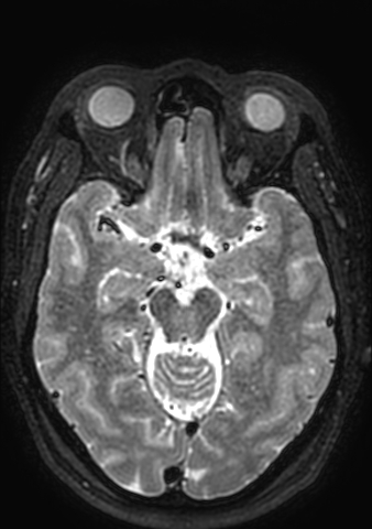 Accessory middle cerebral artery (Radiopaedia 73114-83828 Axial T2 116).jpg