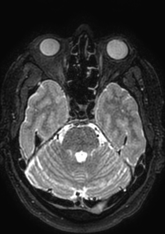 Accessory middle cerebral artery (Radiopaedia 73114-83828 Axial T2 146).jpg