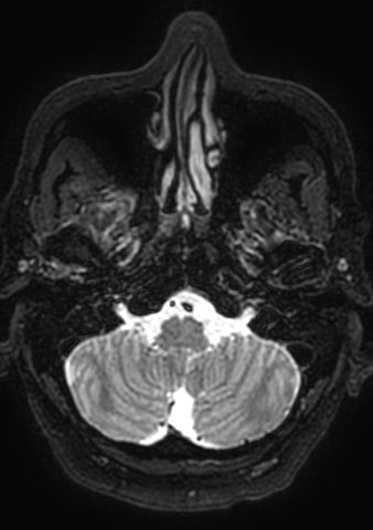 File:Accessory middle cerebral artery (Radiopaedia 73114-83828 Axial T2 192).jpg