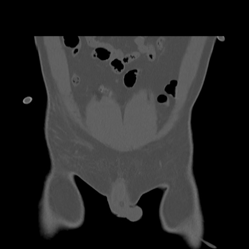 File:Acetabular and ilial fractures (Radiopaedia 59084-66378 Coronal bone window 2).jpg
