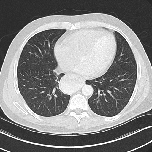 Achalasia of the cardia (Radiopaedia 38497-40595 Axial lung window 35).png