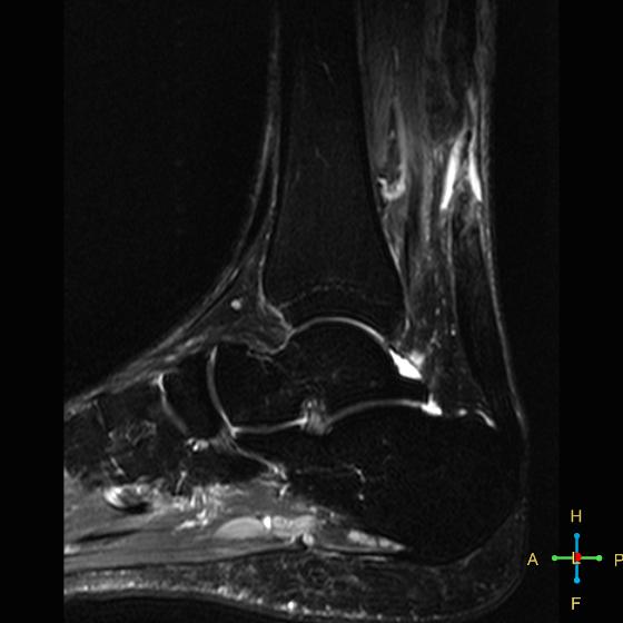 File:Achilles tendon complete tear (Radiopaedia 22834-22854 Sagittal STIR 9).jpg