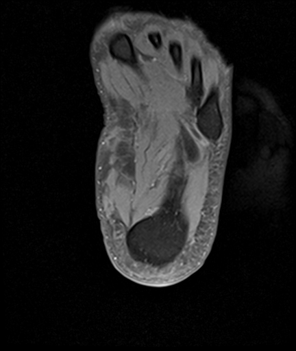 File:Achilles tendon tear (Radiopaedia 77615-89819 Axial PD fat sat 28).jpg