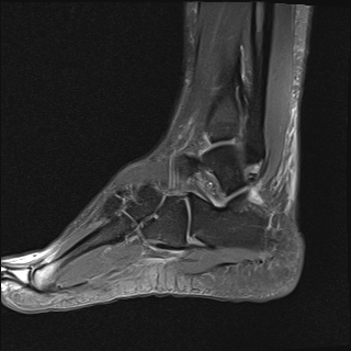File:Achilles tendon tear (Radiopaedia 77615-89819 Sagittal PD fat sat 17).jpg