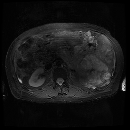 Acinar cell carcinoma of the pancreas (Radiopaedia 75442-86668 Axial T2 fat sat 38).jpg