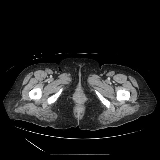 Acinar cell carcinoma of the pancreas (Radiopaedia 75442-86669 Axial C+ portal venous phase 160).jpg