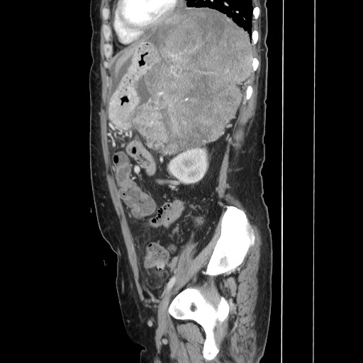 Acinar cell carcinoma of the pancreas (Radiopaedia 75442-86669 Sagittal C+ portal venous phase 133).jpg