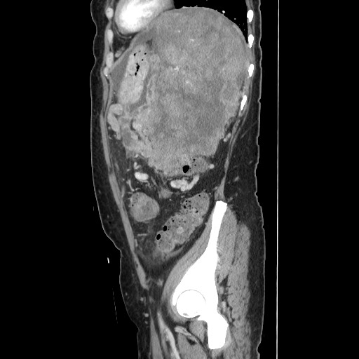 Acinar cell carcinoma of the pancreas (Radiopaedia 75442-86669 Sagittal C+ portal venous phase 142).jpg