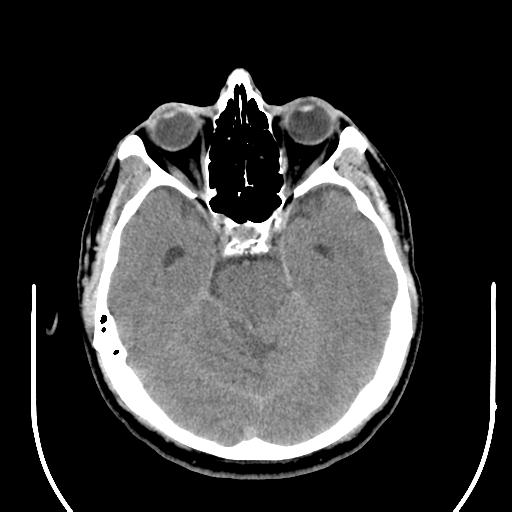 File:Acoustic schwannoma (Radiopaedia 29488-29982 AXIAL THICK non-contrast 17).jpg